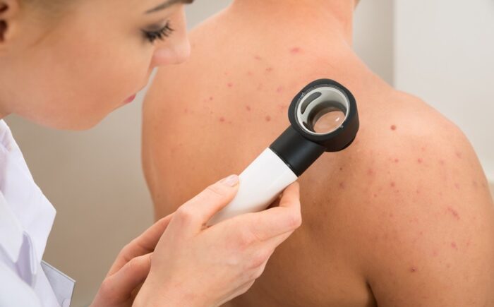 Tecnologia para tratar câncer de pele é aprovada para uso no SUS